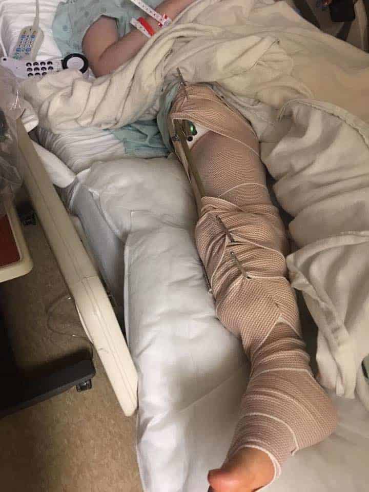 Broken Tibia
